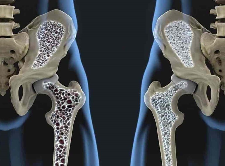 Estudio Bioquímico de Osteoporosis